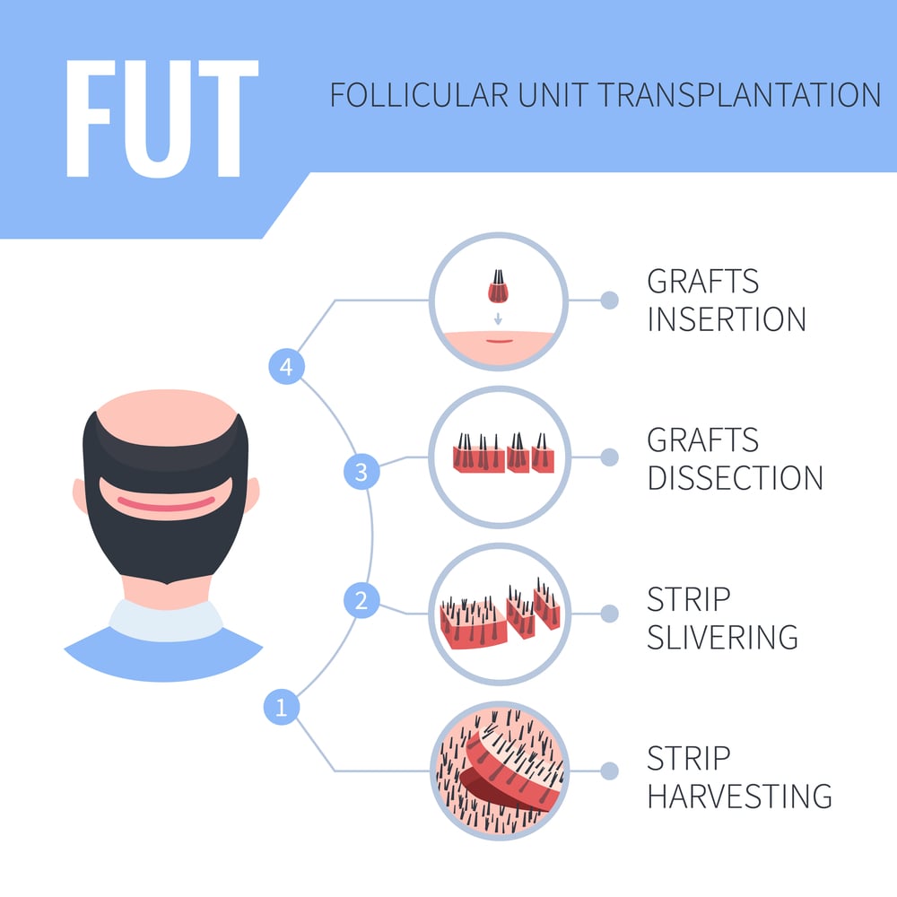 FUT hair transplant