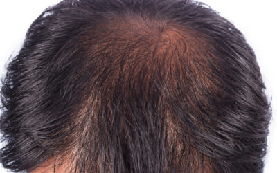 All About Hair Transplants