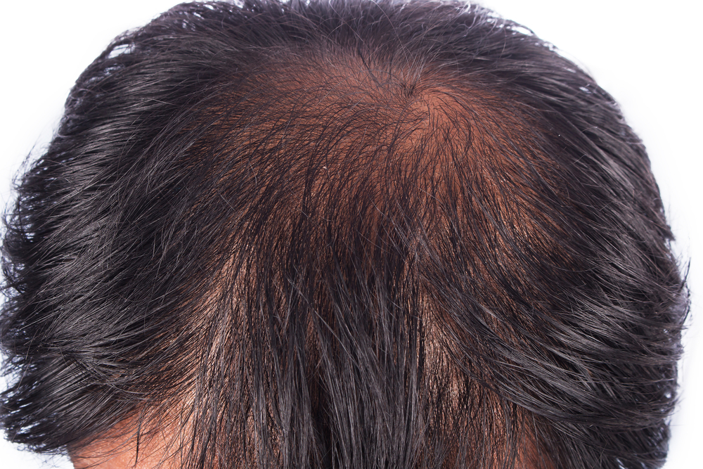 all about hair transplants