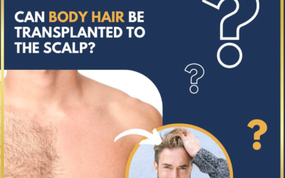 Can body hair be transplanted into the scalp?