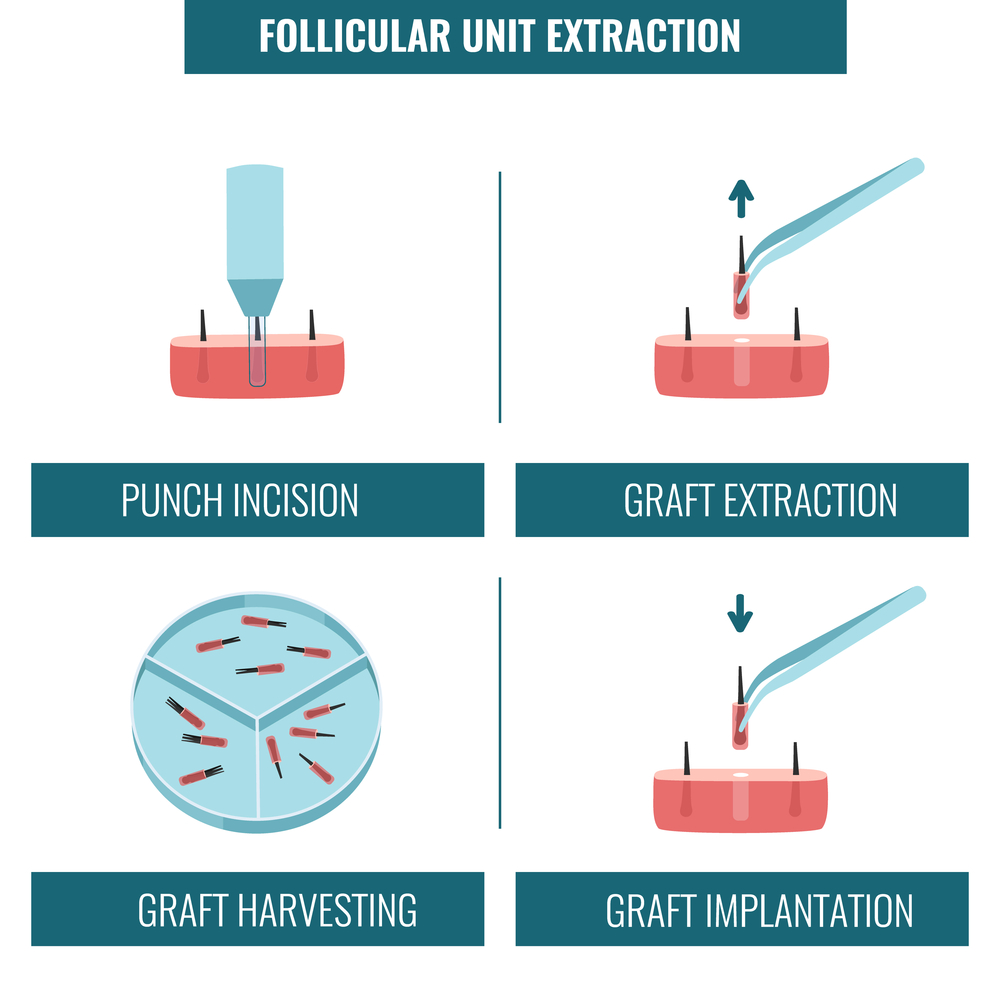 what is a FUE hair transplant?