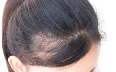 The Benefits of Hair Transplants for Women
