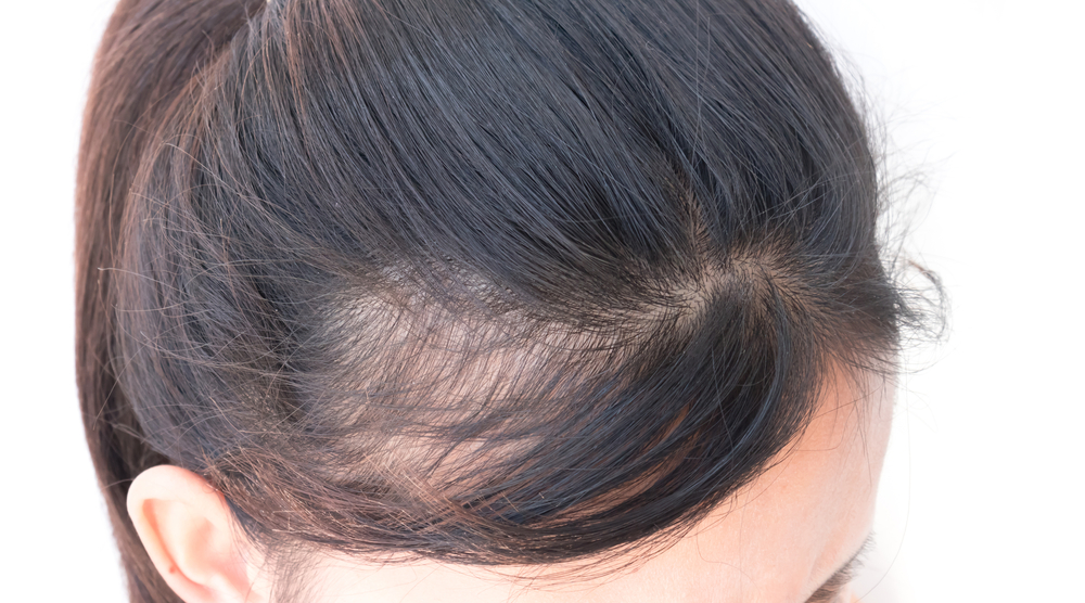 The Benefits of Hair Transplants for Women