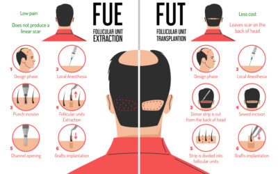 The differences between FUE and FUT hair transplants