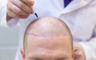 Hair Transplant Costs – What You Need to Know