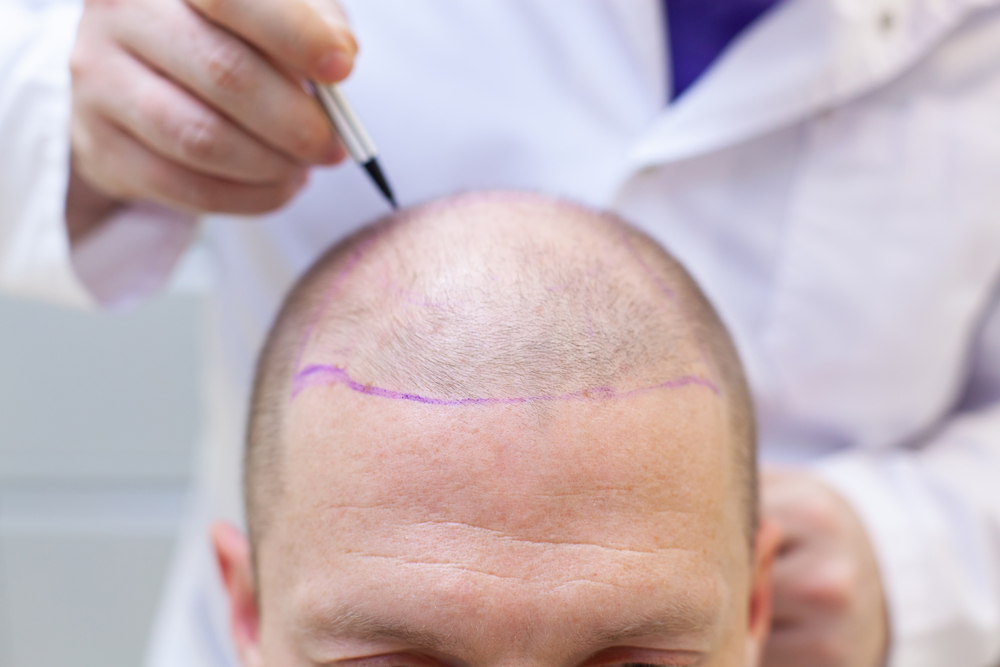 Hair Transplant Costs – What You Need to Know