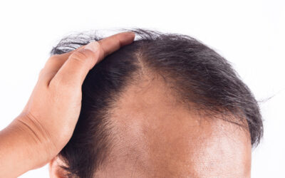 Why hair transplants are not cheap