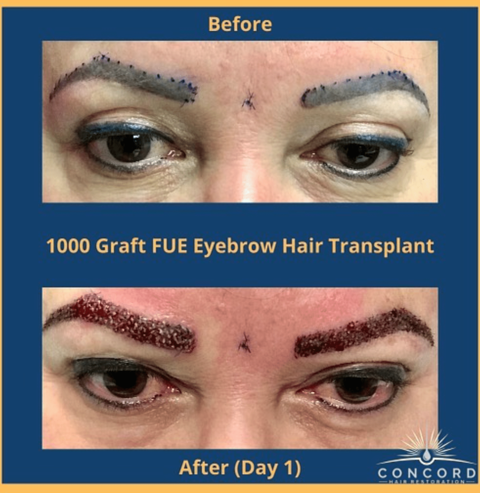 eyebrow transplant before and after