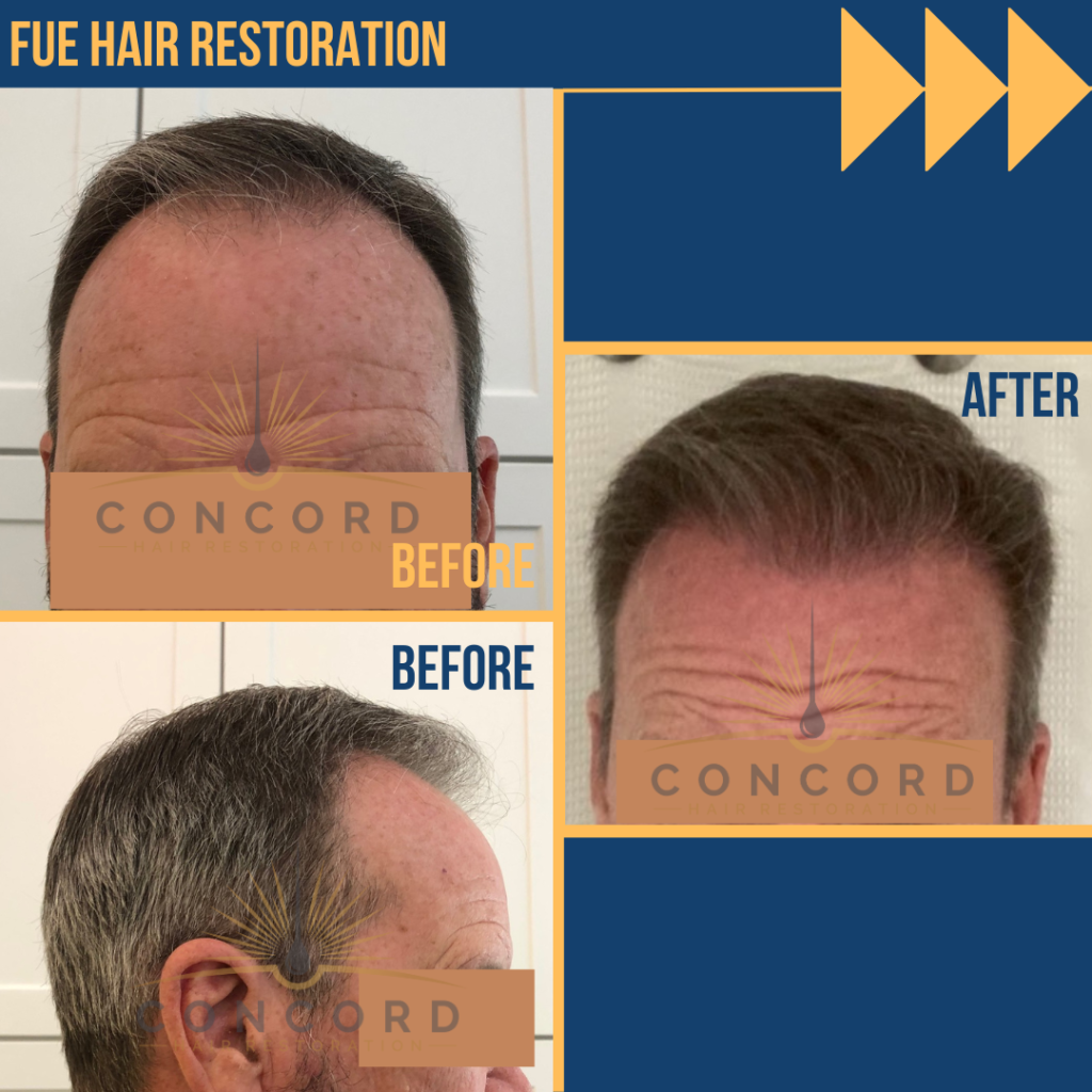 hair transplant before after Los Angeles