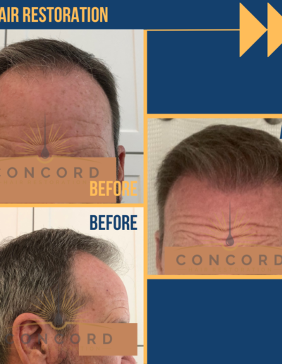 hair transplant before after Los Angeles