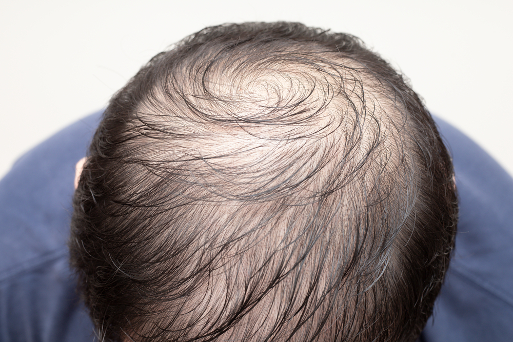 What is the Best Los Angeles Hair Restoration Procedure to Minimize Recovery Times