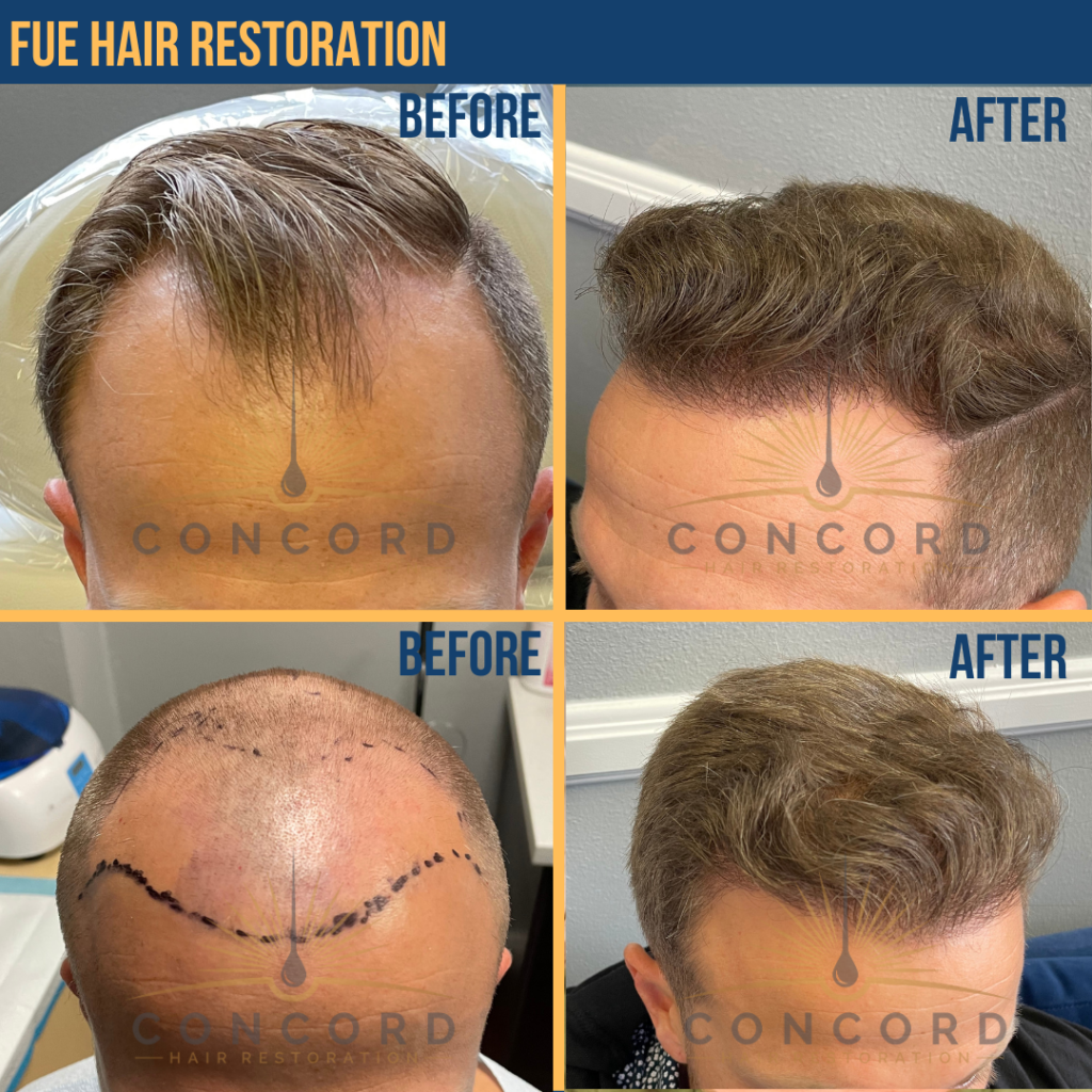 Los Angeles hair transplant before after