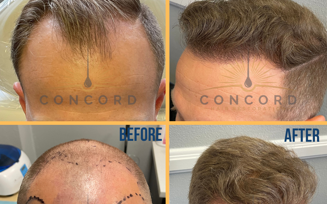 Los Angeles hair transplant before after