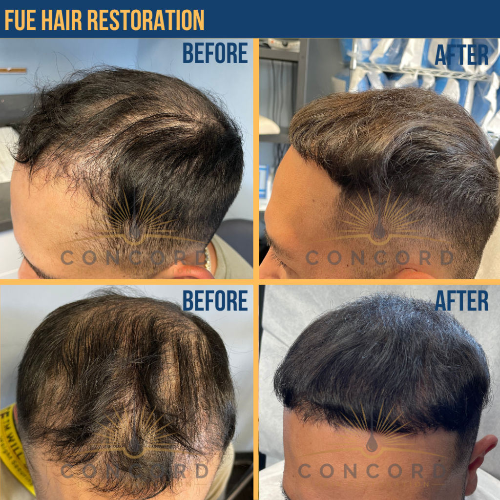 hair restoration before after San Diego