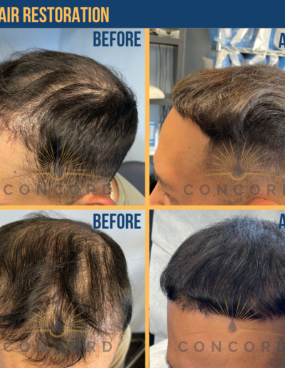 hair restoration before after San Diego