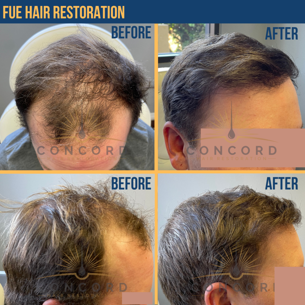 hair transplant Los Angeles cost