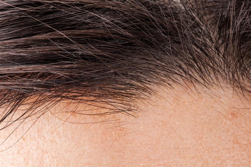 Before and after images of a successful hair transplant, showcasing its lasting effects