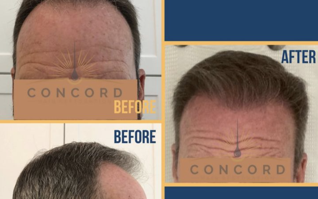 Before and after images of successful FUE hair restoration at Concord Hair Restoration, showcasing natural-looking, dense hairlines