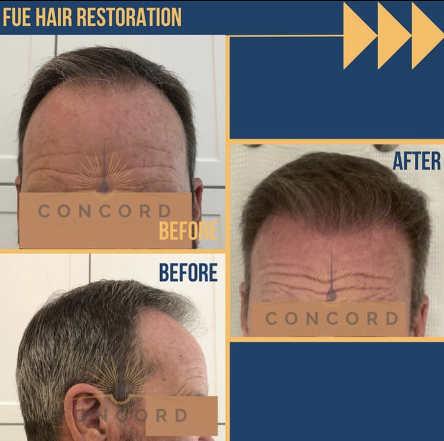 Before and after images of successful FUE hair restoration at Concord Hair Restoration, showcasing natural-looking, dense hairlines