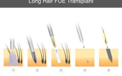 FUE Hair Grafts: Essential Guide for Optimal Results