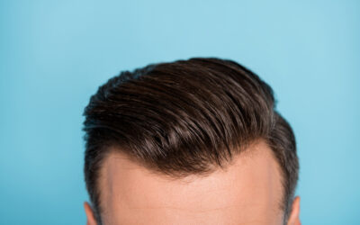 Can People Tell If You’ve Had a Hair Transplant?