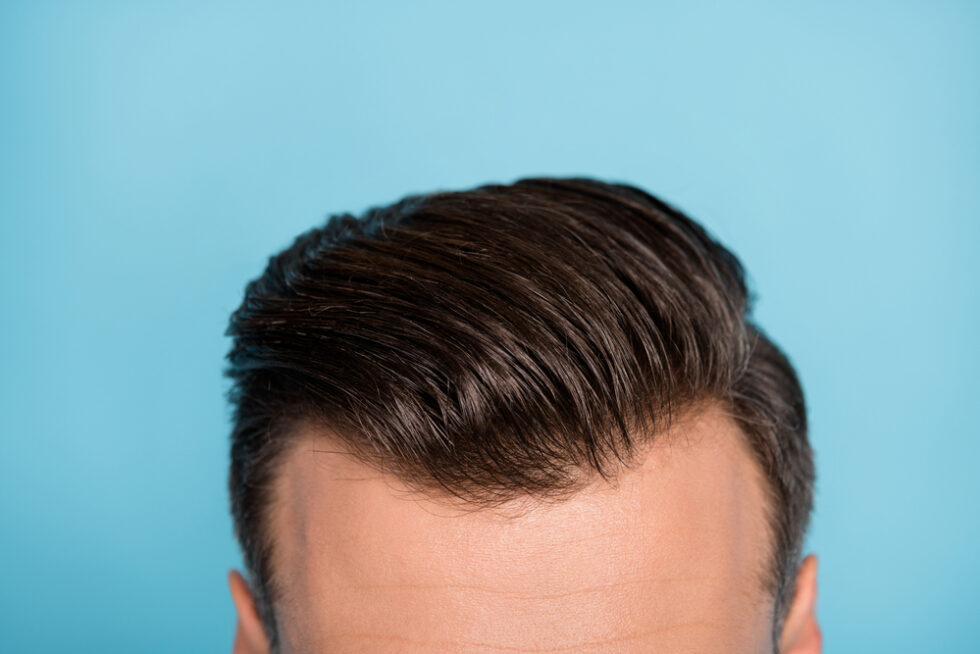 can-people-notice-your-hair-transplant-expert-insights-tips