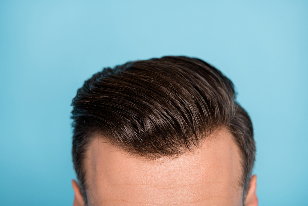 A confident individual showcasing a natural-looking hairline, embodying the success of modern hair transplant techniques.