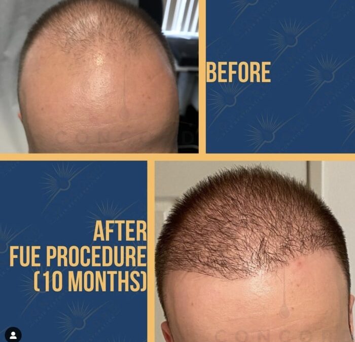 hair restoration cost in San Diego