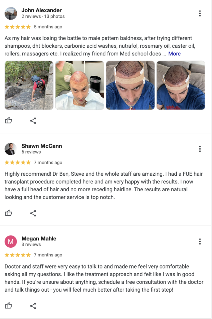 REAL Hair Transplant Reviews in San Diego