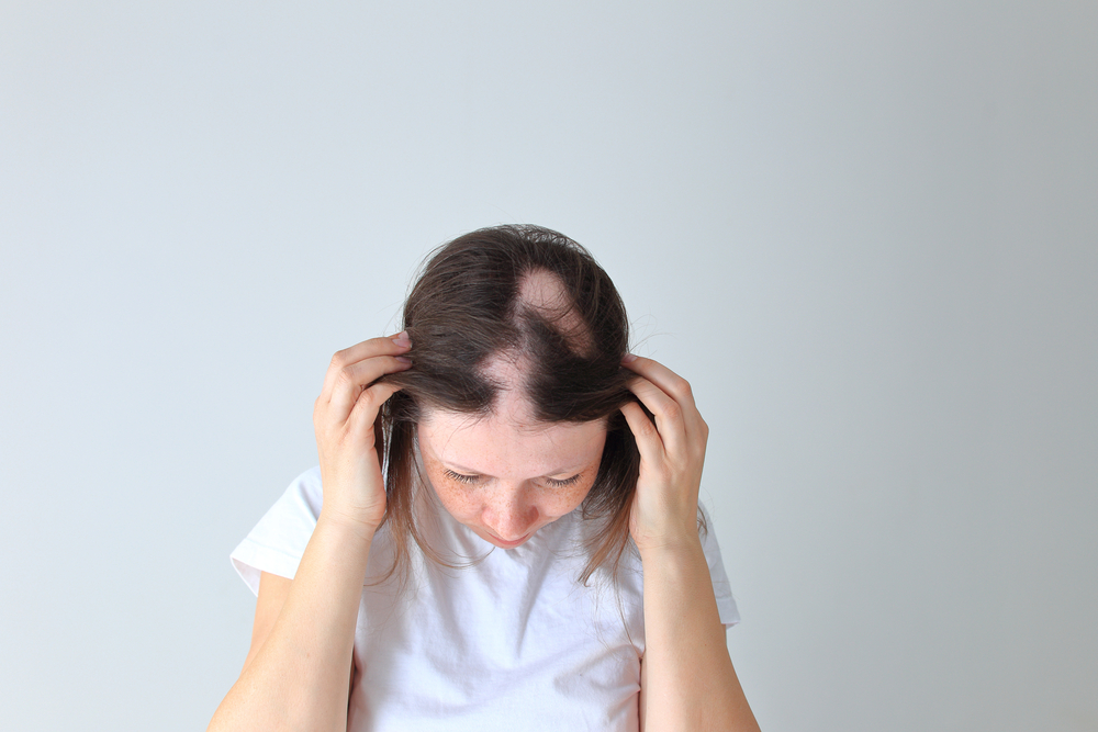 Hair Loss in Women: Reclaiming Your Confidence with FUE Hair Transplants