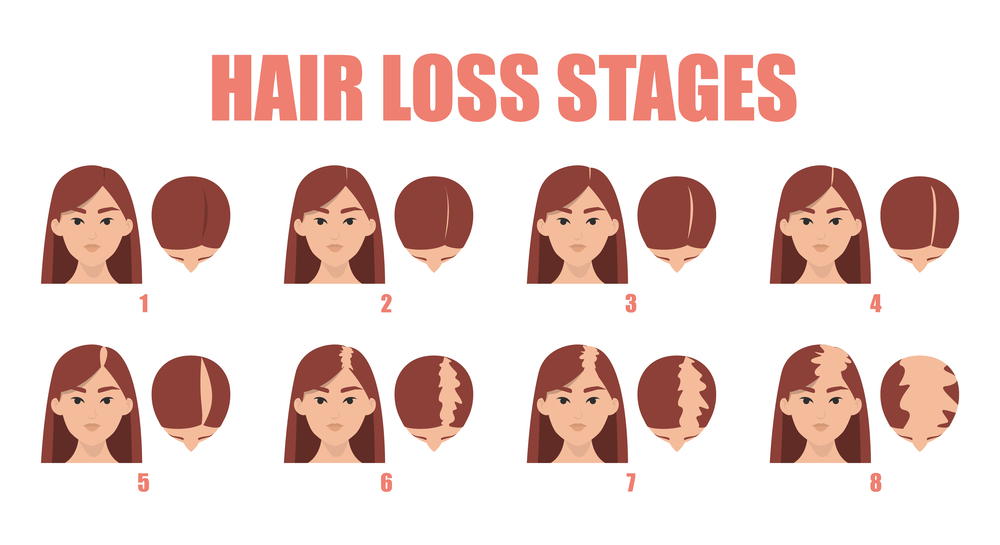 female hair loss pattern