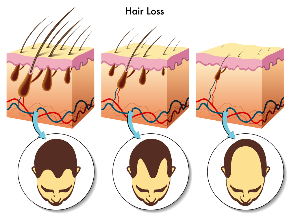 hair loss explained