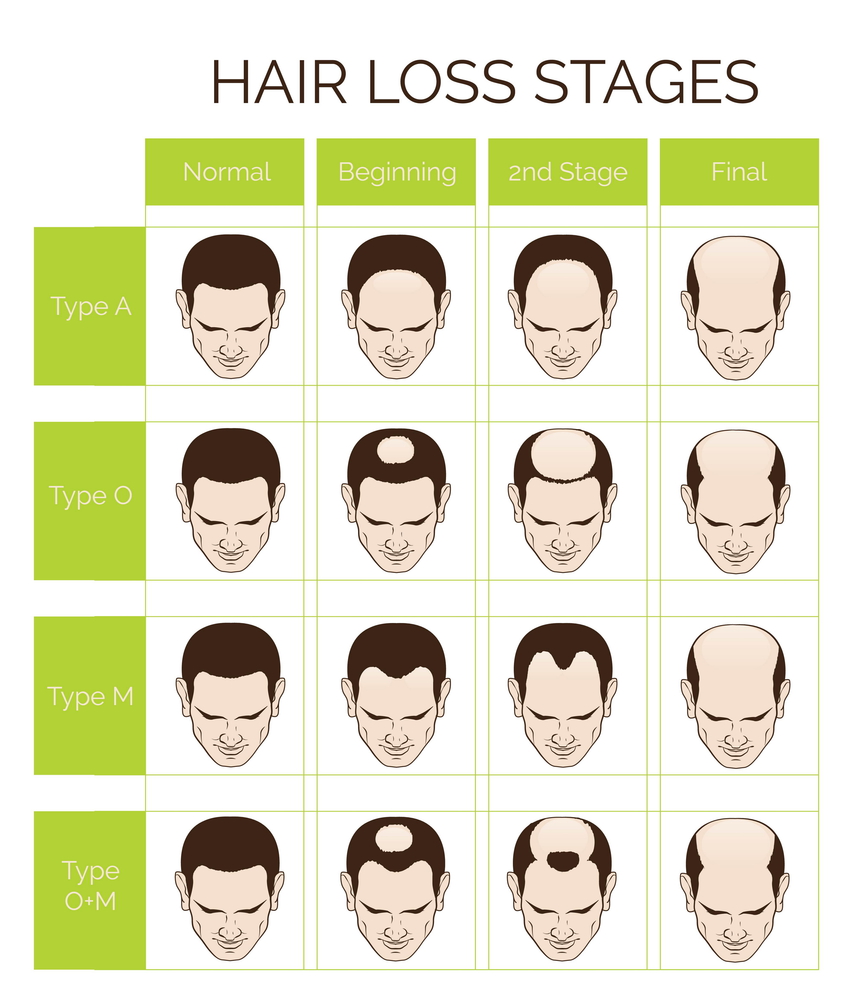 Hair loss stages and types for men
