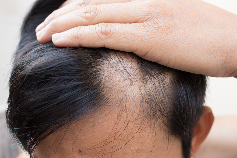 signs of men's hair loss