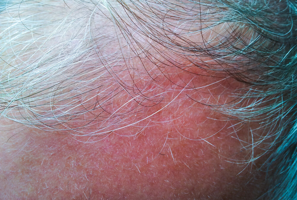 Aging and Hair Loss