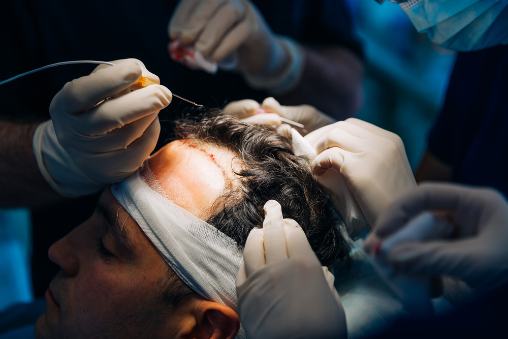 Why Los Angeles is the Best City for Advanced Hair Transplant Techniques