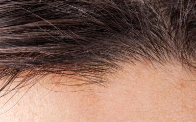 Navigating Hair Transplant Regulations and Standards in California