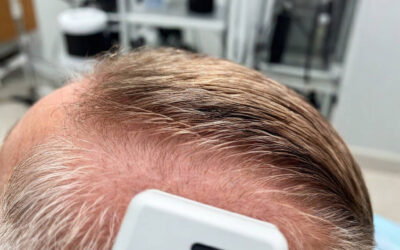 The Future of Hair Restoration: Emerging Technologies in Hair Transplantation