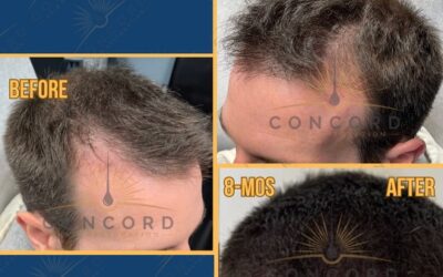 Custom Hairline Design: How Advanced Tech is Transforming Hair Transplant Results