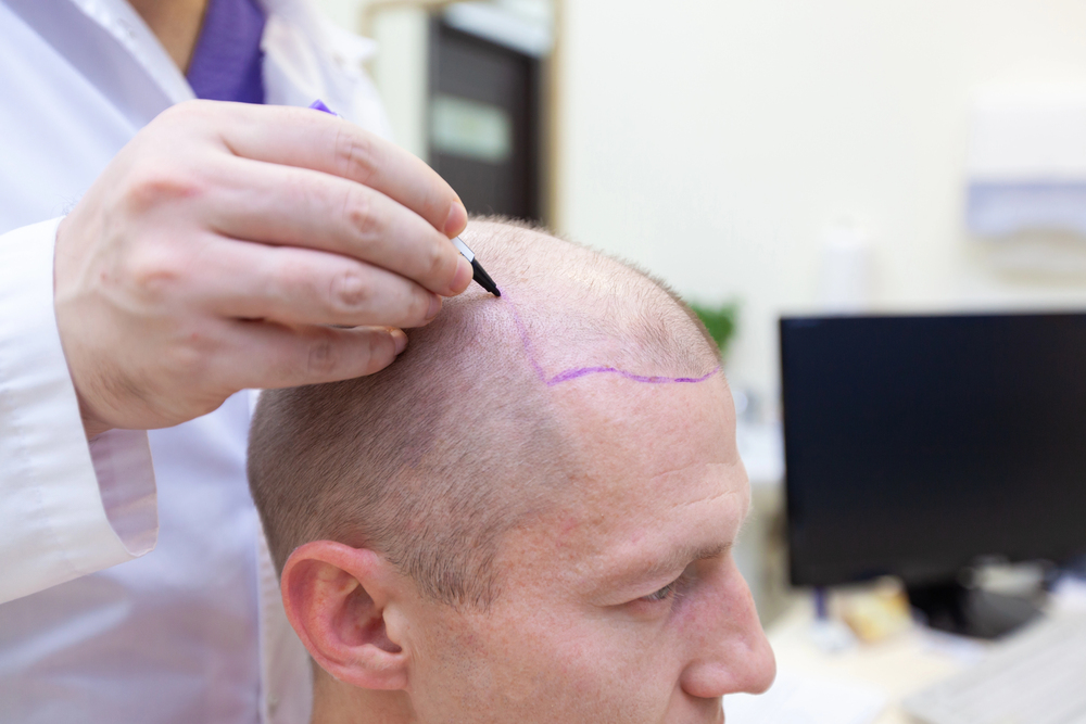 Hair Transplant Tourism vs. Local Expertise: Why LA Delivers Better Results