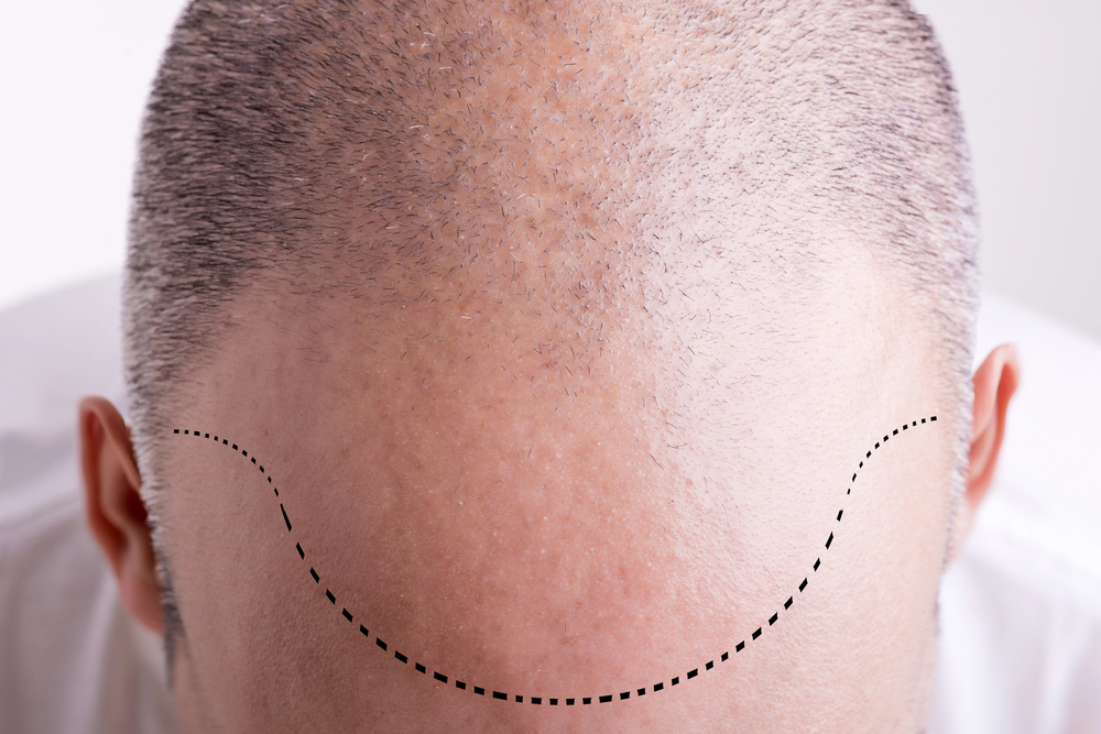 How Hair Transplants Improve Facial Symmetry