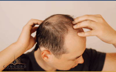 Hair Transplant Density Explained: What “Full” Actually Means