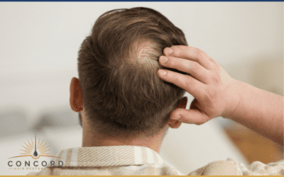 Diffuse Thinning vs Bald Spots: How Hair Restoration Planning Changes