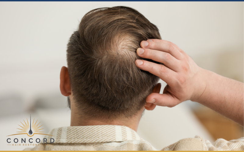 Diffuse Thinning vs Bald Spots: How Hair Restoration Planning Changes