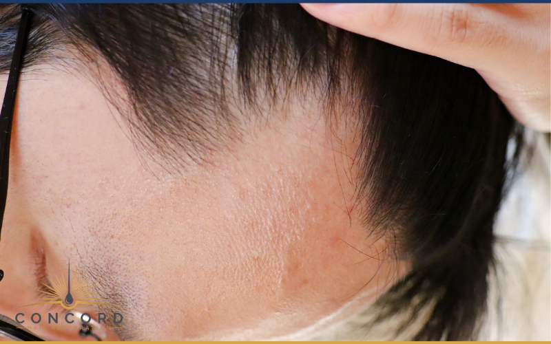 norwood scale hair loss stages male pattern baldness chart