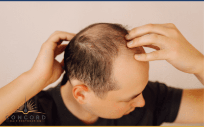 The Norwood Scale Explained: What It Means for Hair Transplant Candidacy