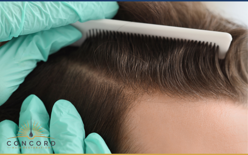 undetectable hair transplant results los angeles lifestyle