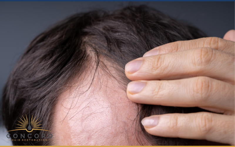 Los Angeles Hair Transplant Clinics vs Turkey