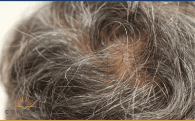 Los Angeles Hair Transplant Clinics vs Turkey: What You’re Really Paying For