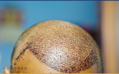 How Many Grafts Do You Need for a Hair Transplant in Los Angeles?